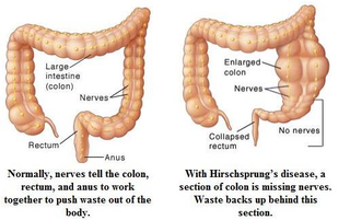 Enfermedad de Hirschsprung. mychart.geisinger.org